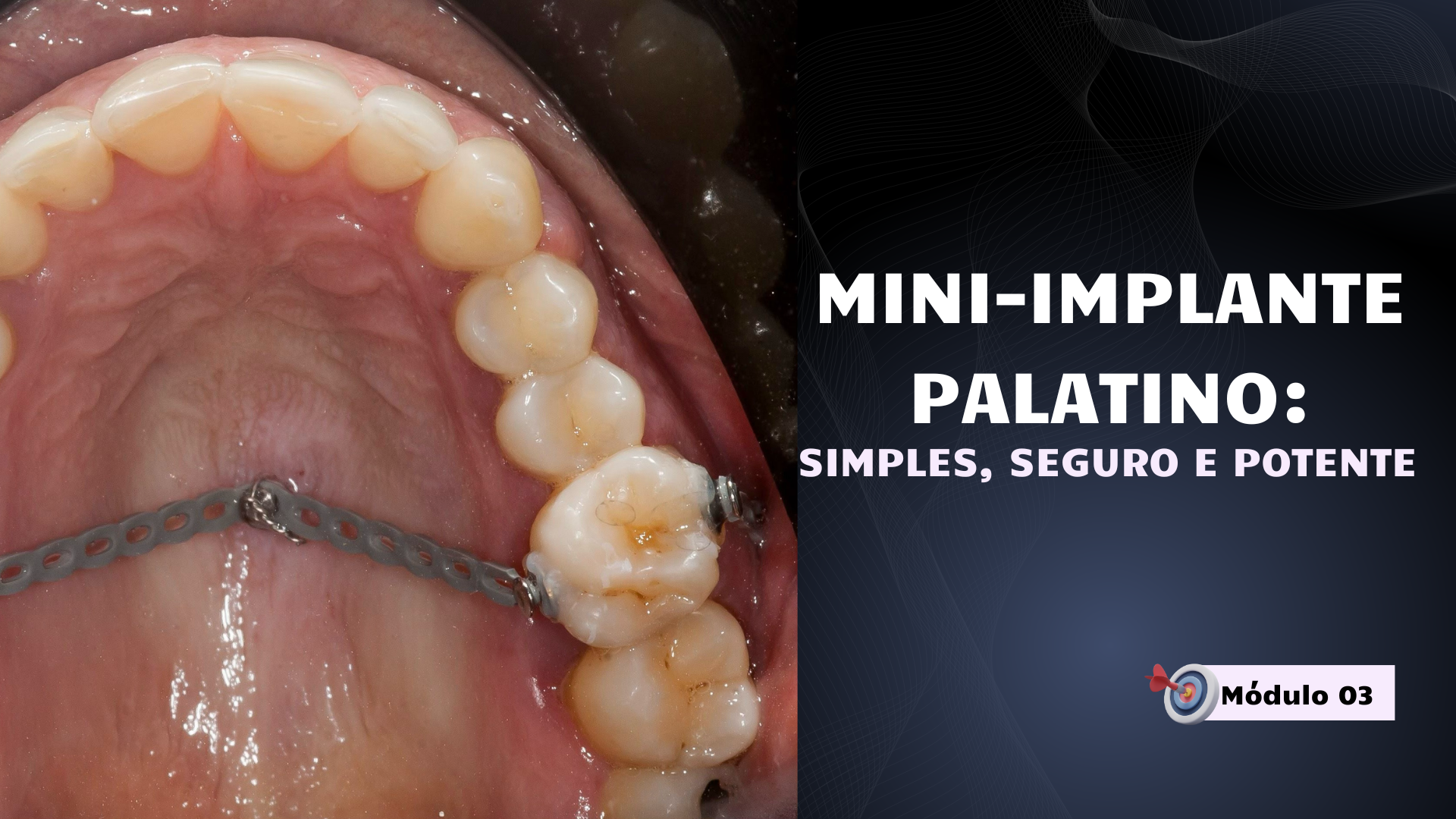Representação gráfica de estabilidade e segurança no uso de mini-implante palatino