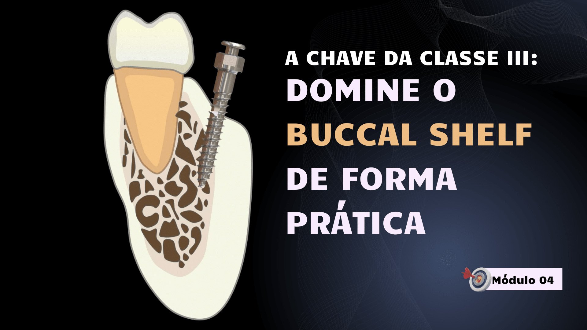 Imagem conceitual representando força e técnica ortodôntica aplicadas na Classe III