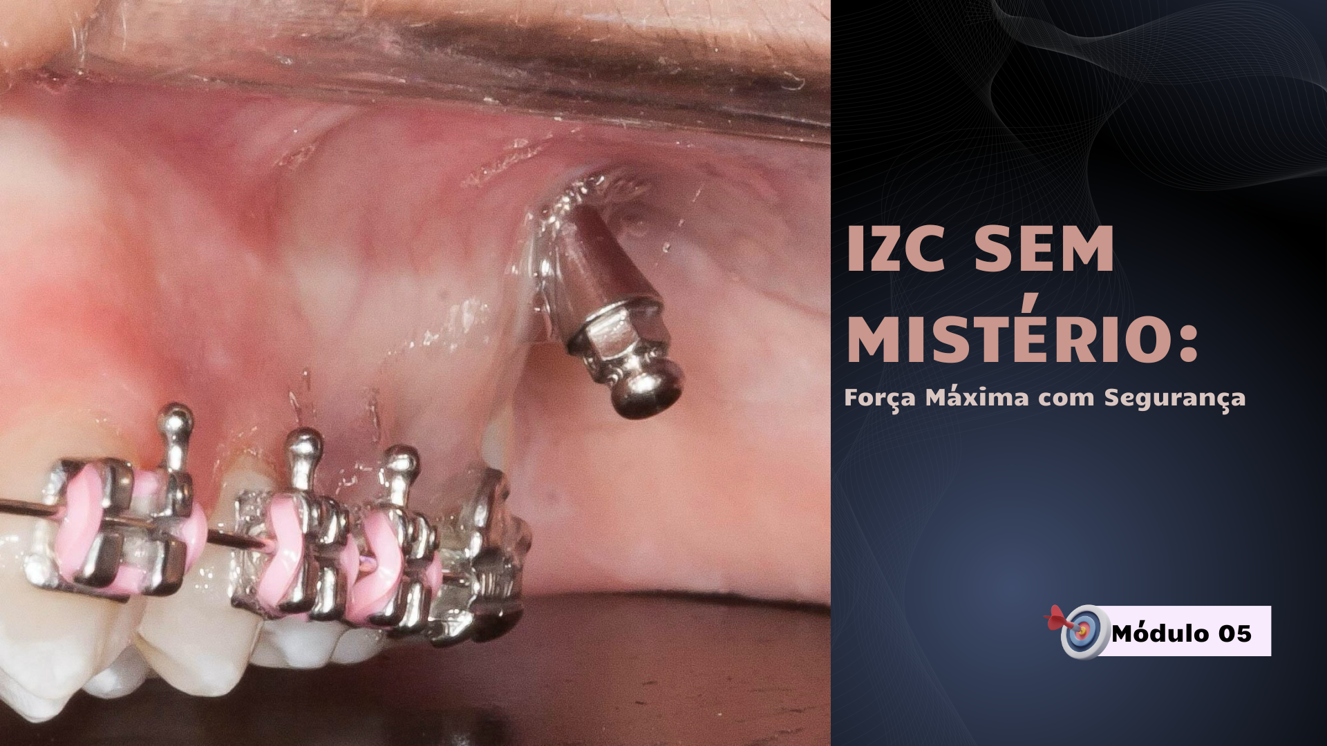 Representação conceitual de técnica potente para instalação de mini-implantes na crista infra zigomática