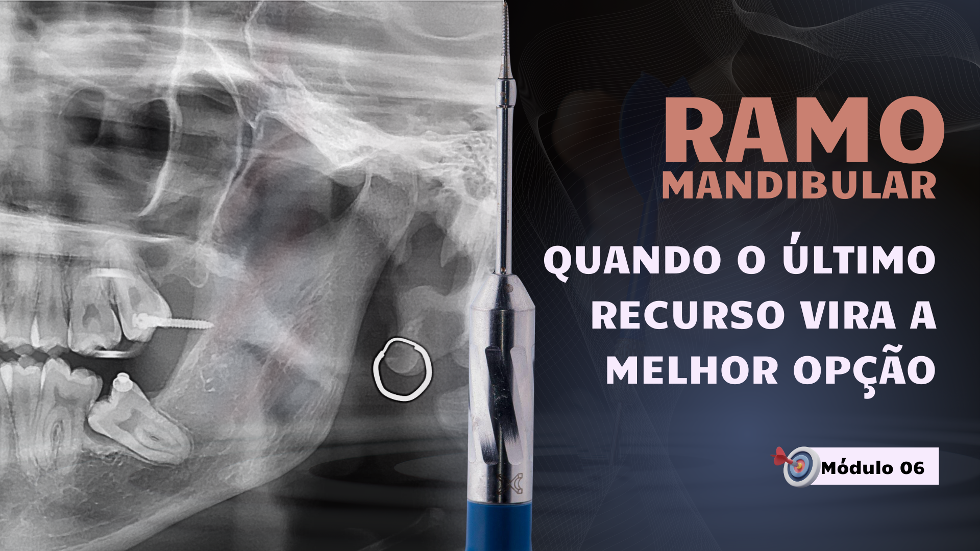Representação simbólica de decisões clínicas avançadas com uso de mini-implantes no ramo mandibular