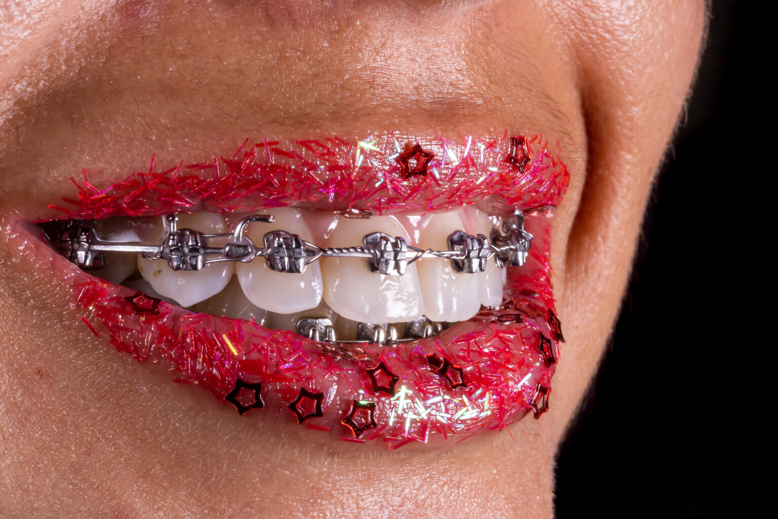Sorriso com aparelho ortodôntico fixo: bráquetes metálicos colados nos dentes